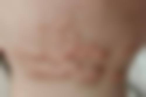 术后去疤痕至佳时间:术后3个月真的关键吗?