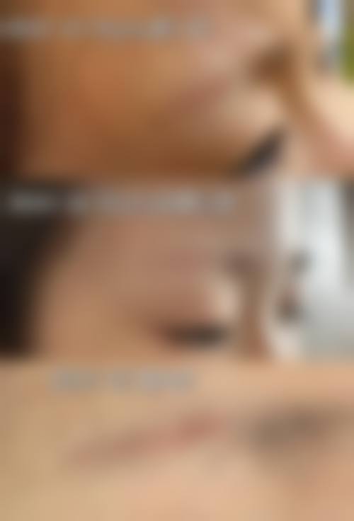 激光祛疤:效率高消除术后疤痕的利器?