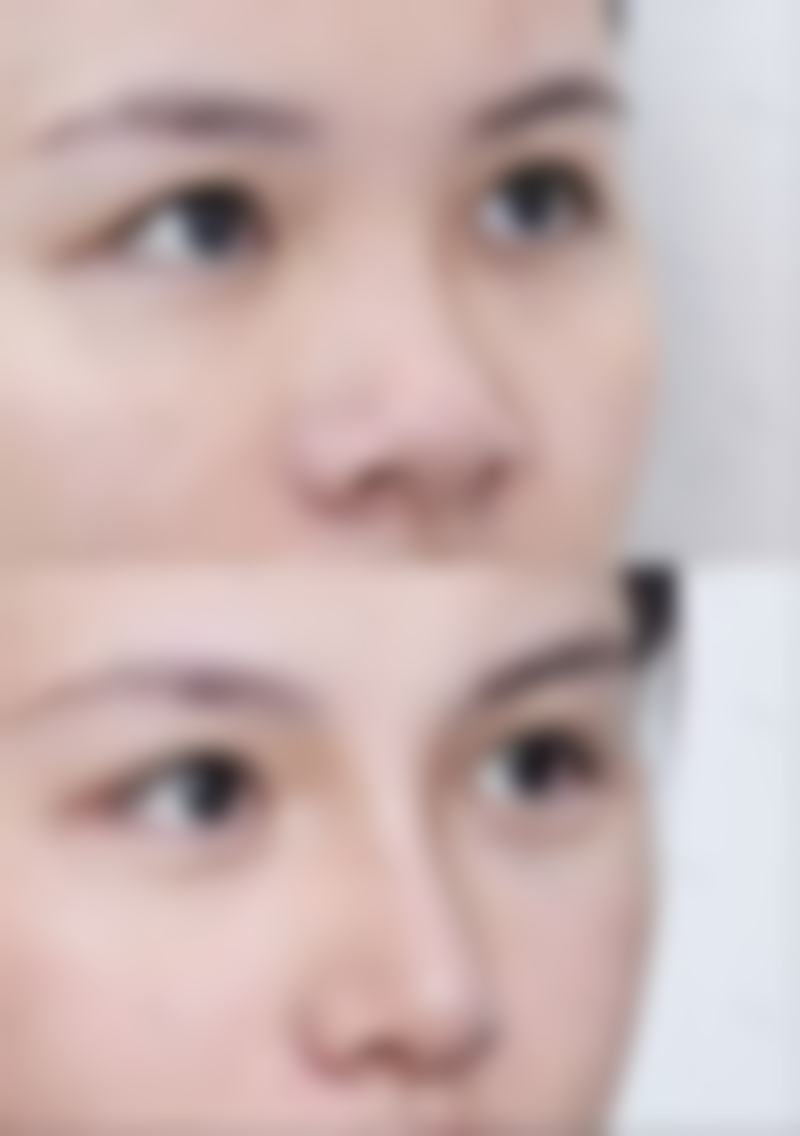 热玛吉除皱的长期变化趋势中，哪些是不可逆的