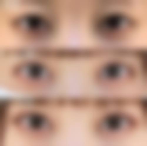 喂奶可以做双眼皮吗通常在什么阶段被纳入医疗选择范围？