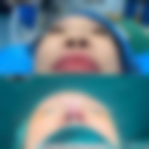 隆鼻手术的价格因素