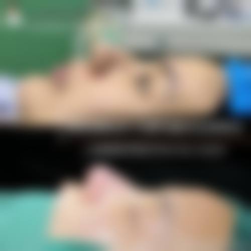 隆鼻手术的修复时间及注意