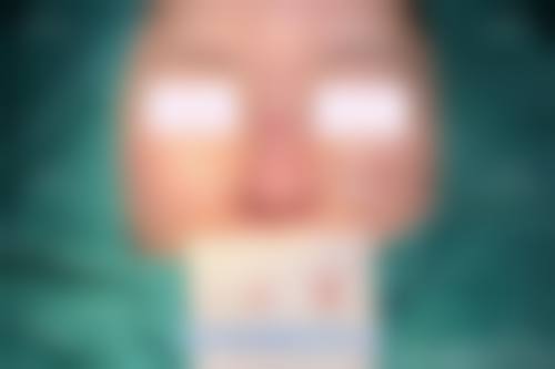 隆鼻手术后遗症及预防