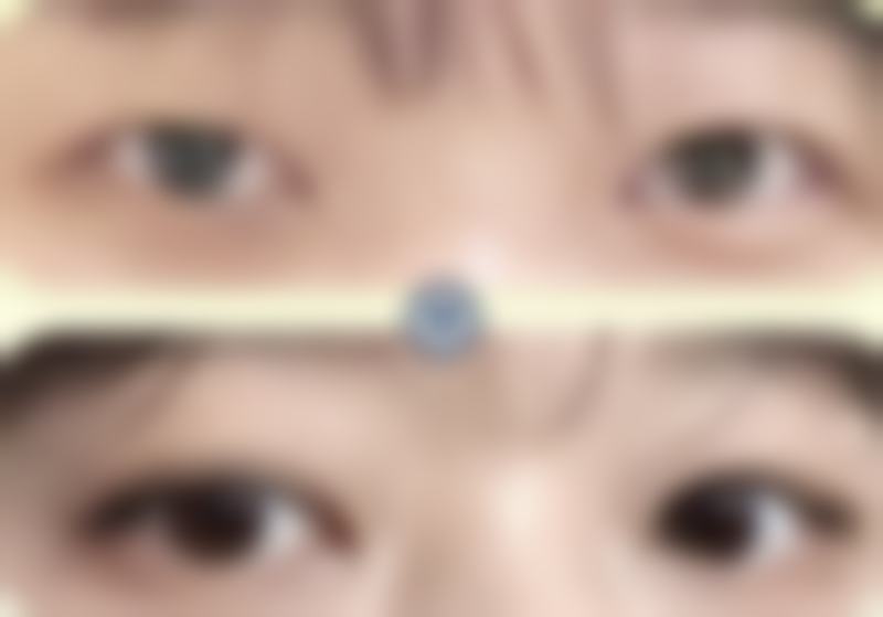 眼袋大黑眼圈是身体哪里出现了问题