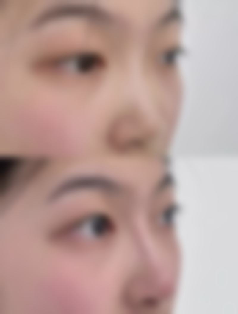 隆鼻手术的适合人群与不适合人群