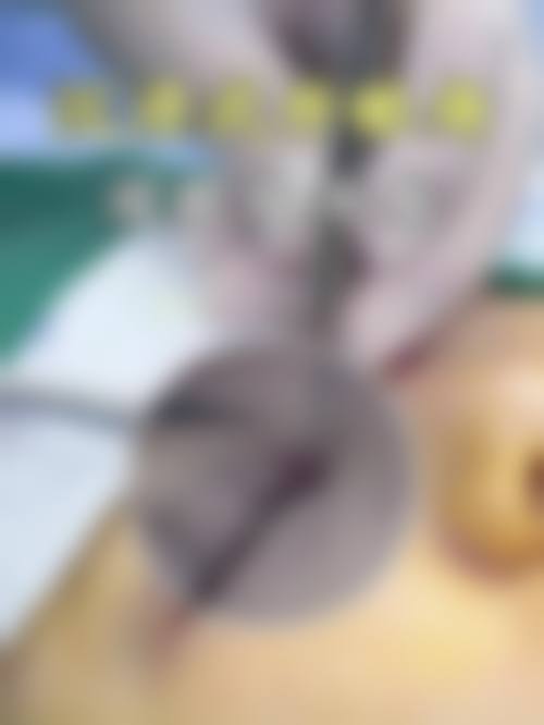 操作路径与方案选择和割眼袋后复发的关系