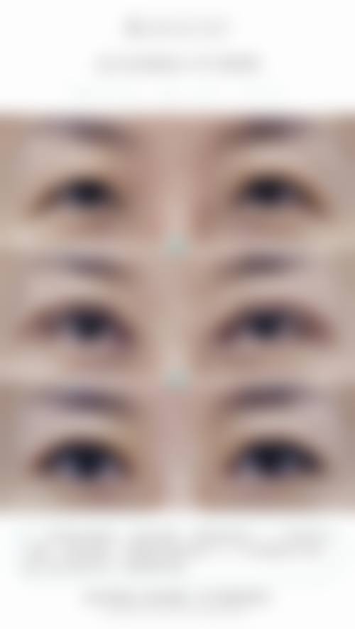 割眼袋后相关疑问的综合解答