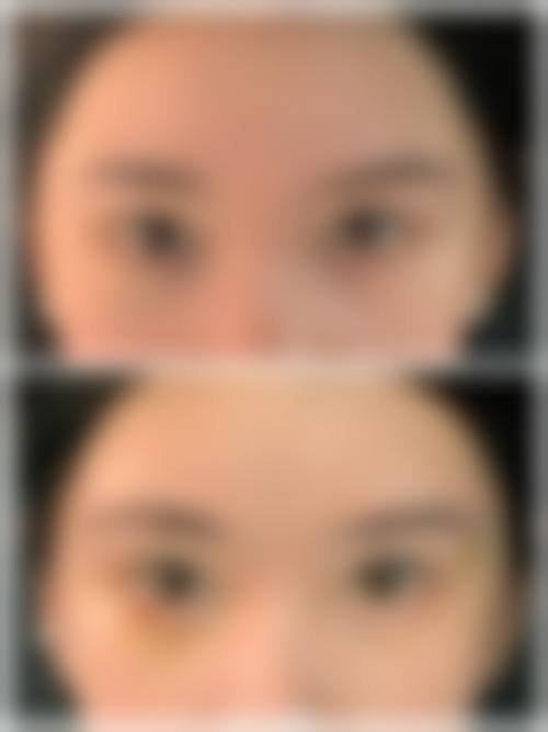 割眼袋后会复发吗？会不会反弹？上海陈小剑5年复发率<3%，复发可修复