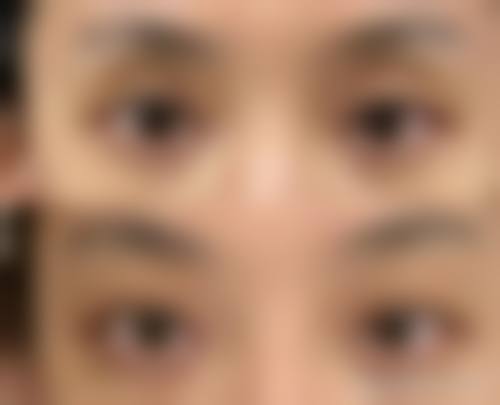 个体基础条件对割眼袋后复发的影响