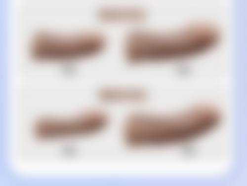 怎么判断我是否适合线提升隆鼻项目？