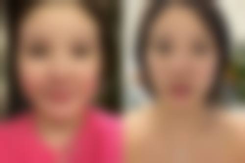 线提升隆鼻的定价在3000 - 15000元合理吗？