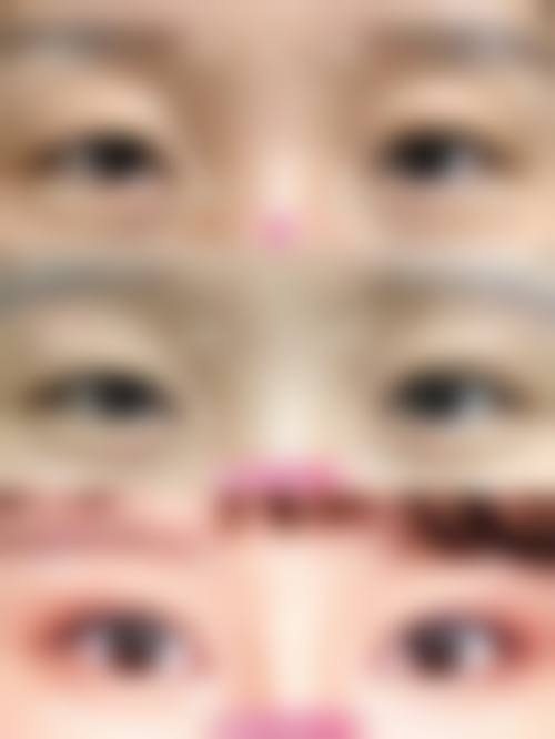 如何为割眼袋手术设定一个合理且可验证的成效目标