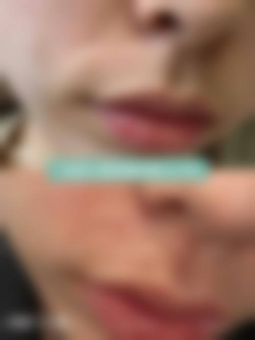 割眼袋后会凹陷吗？这些因素是关键！割完眼袋会留疤吗？应对方法大揭秘 