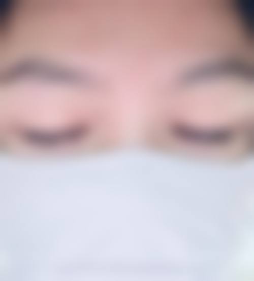 术后90天脱落期的原因