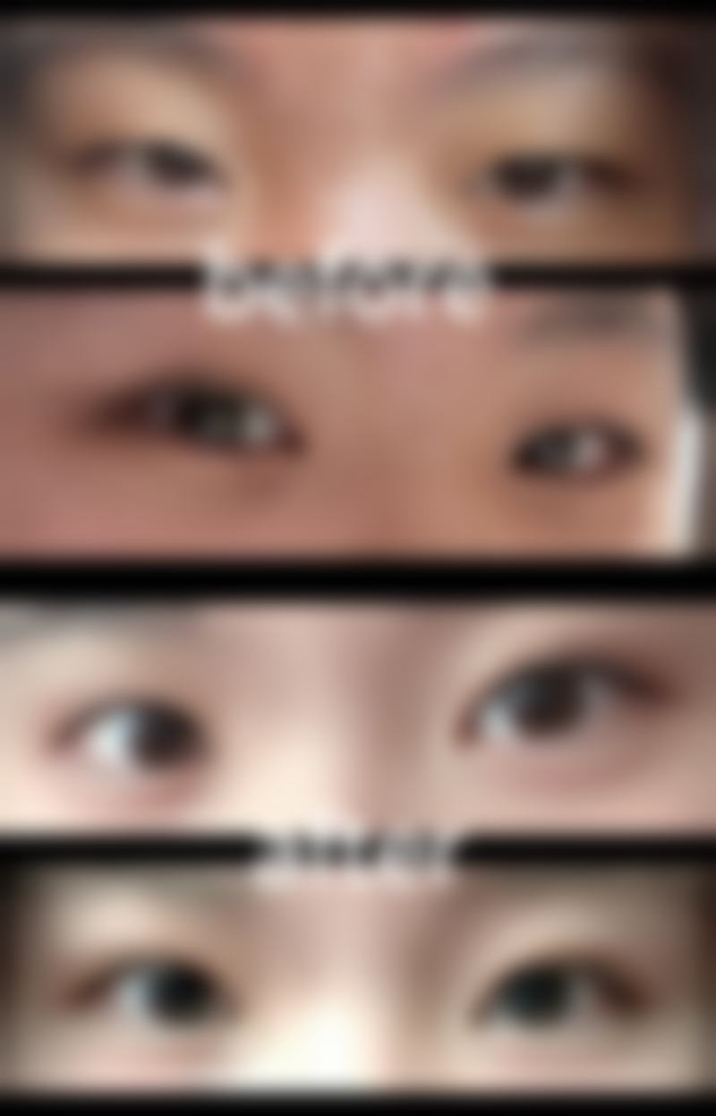 割双眼皮后遗症的重度程度如何判断?