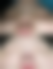 割双眼皮后出现后遗症该怎么办?及时补救特别重要