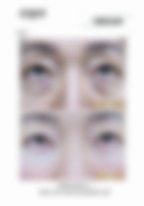 双眼皮手术后注意哪些护理要点