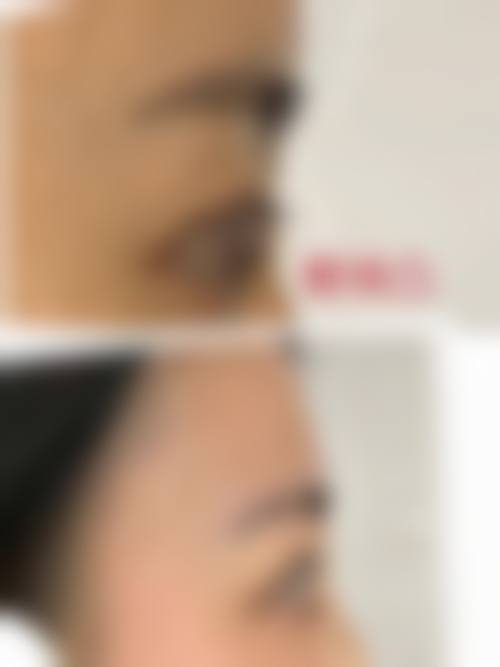 定点双眼皮通常在什么阶段被纳入医疗选择范围?