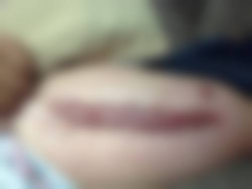 脸上有疤痕如何修复