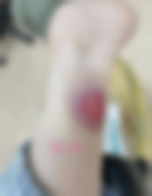 按摩修复脸上疤痕手术或治疗成效能维持多久?