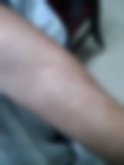 按摩修复脸上疤痕常见并发症或后遗症,真实发生概率如何?