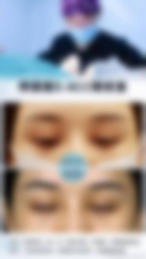 美杜莎双眼皮好不好？优势大揭秘！与普通双眼皮区别显著，价格16000 - 20000元不等 