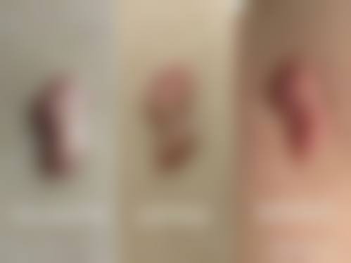 疤痕激光修复要多少钱？一般一次500 - 2000元，通常3 - 5次能修复回来！ 