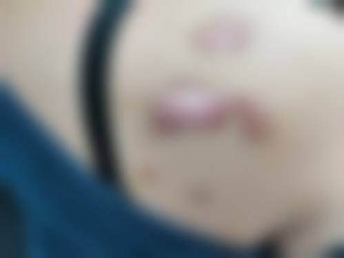 激光治疗凸起疤痕会复发吗