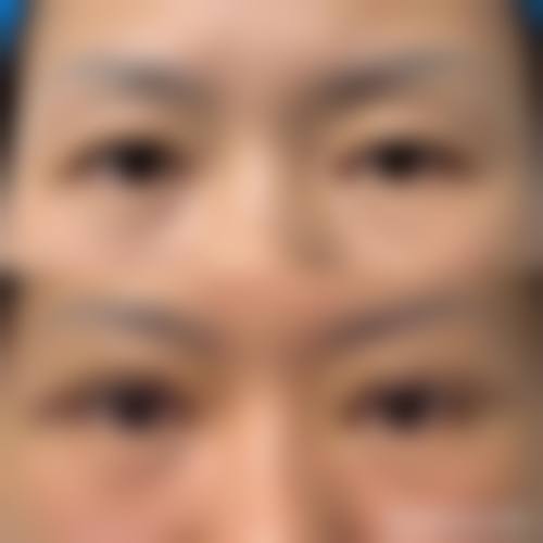 四、埋线双眼皮修复的术前准备