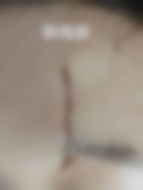 面部伤口多久结痂及愈合