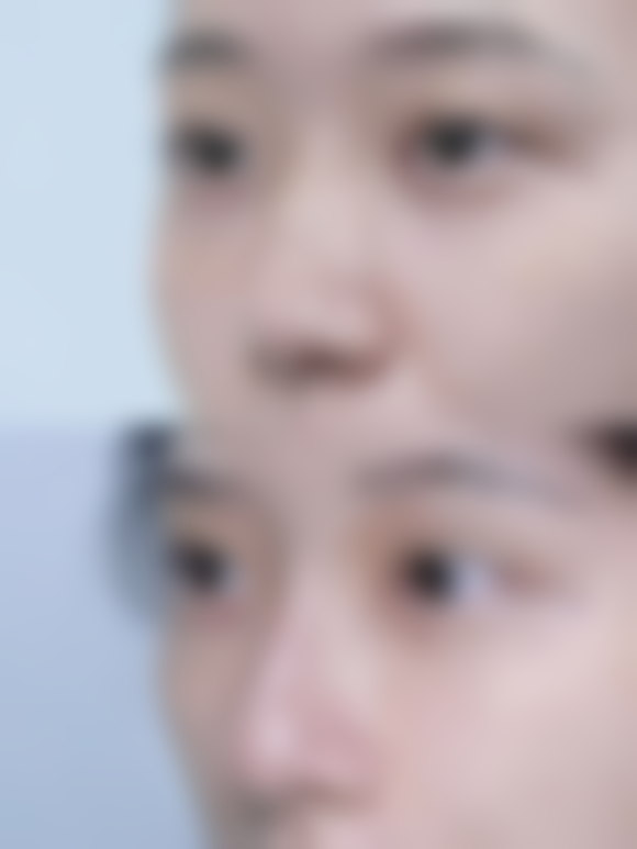 六、更终如何确定自己适不适合双眼皮？专精评估不可少