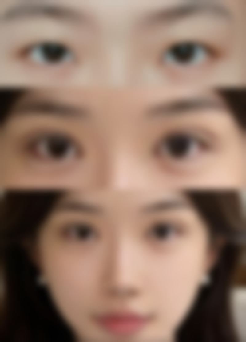 二、如何看自己适不适合双眼皮？眼部基础条件是重点