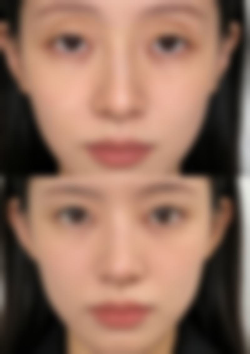 三、如何看自己适不适合双眼皮？不同眼型有不同适配度