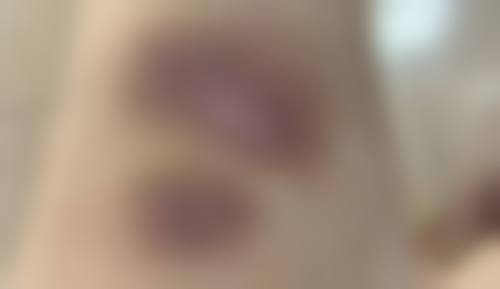 五、切缝疤痕手术安心吗 / 有哪些风险