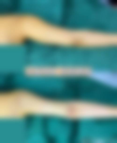 如何精细判断自己的吸脂拆线时间？找医生就对啦！