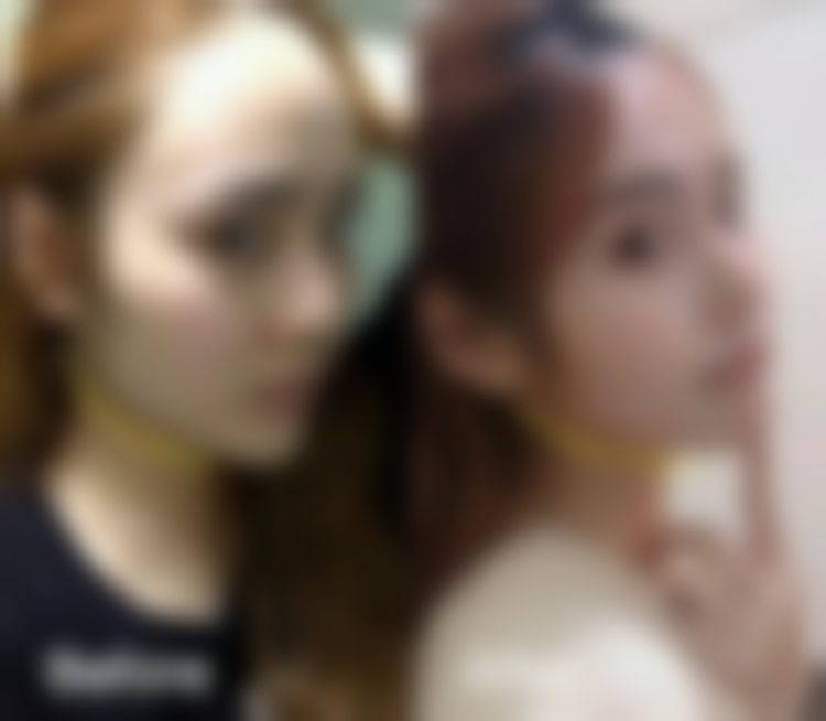 杭州瘦脸针多少钱？戴柳丽医生美国品牌50单位瘦咬肌1515元起，正品可验限购一次！