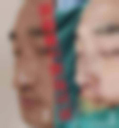 六、隆鼻感染高发期分析