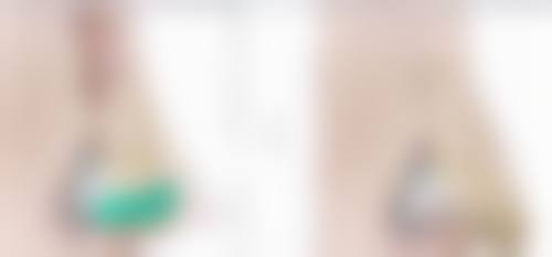 七、隆鼻感染怎么治疗