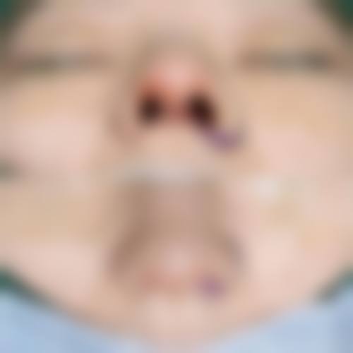 二、材料特性引发的感染风险