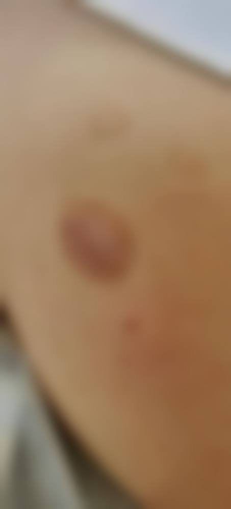 五、西安光仁丁医生整形医院真实实例参考