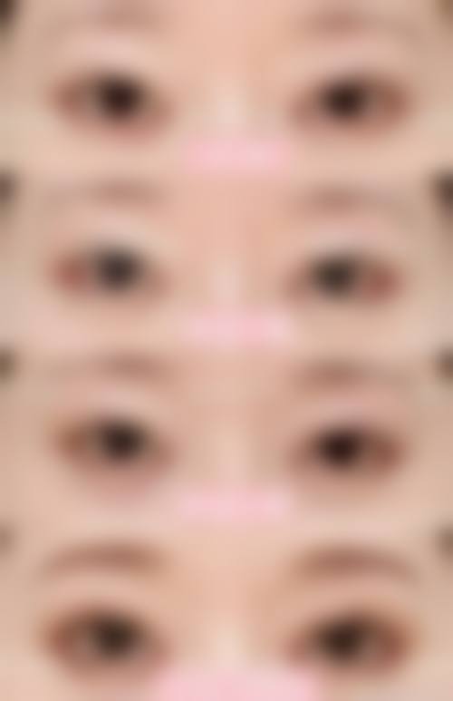 三、全切双眼皮2个月修复图揭秘