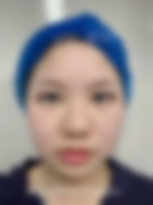 八、全切双眼皮修复医院医生如何选择