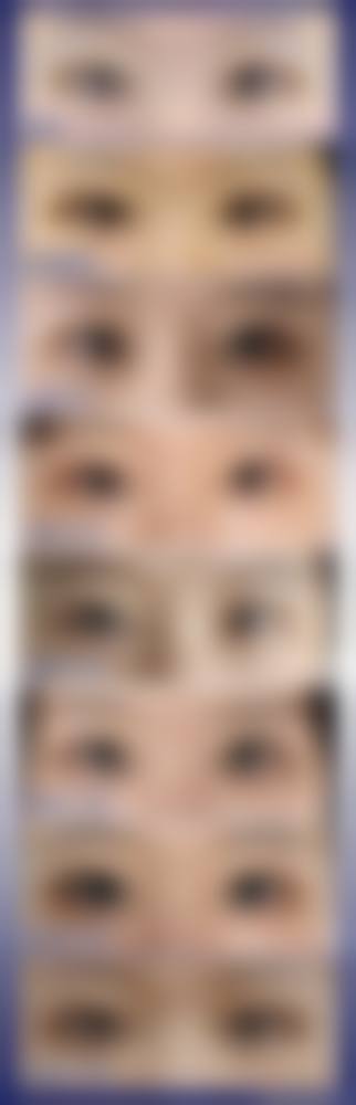 七、怎么判断自己是否适合做眼袋手术