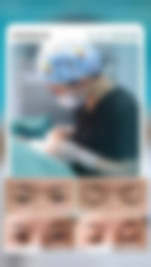 四、全切双眼皮修复成效如何
