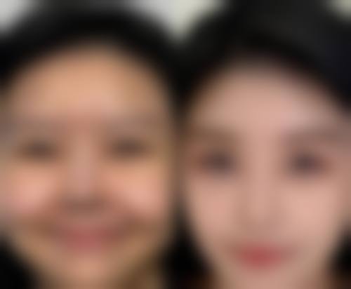 九、bt胶原枪的风险与后遗症