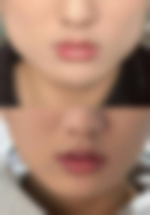 不同场景下瘦脸针单次注射剂量是多少？