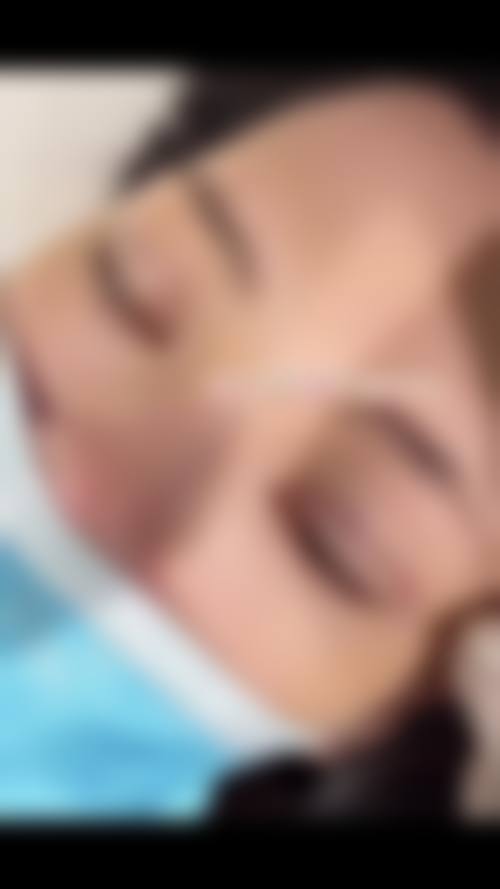 五、双眼皮拆线前后护理全攻略，助力快速修复