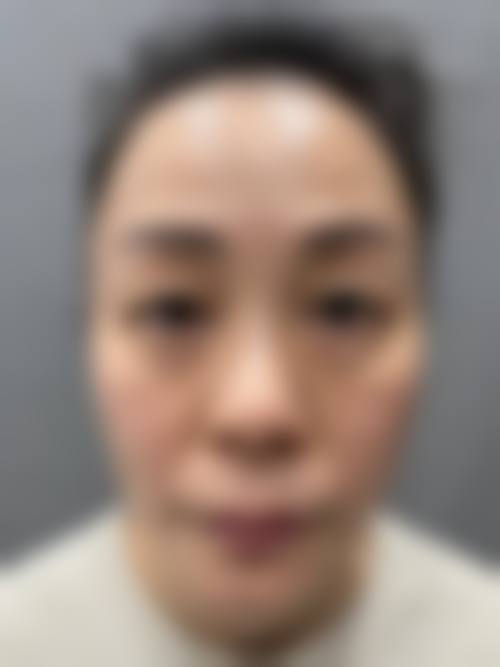 三、双眼皮术后拆线医院怎么选？避坑攻略看这里
