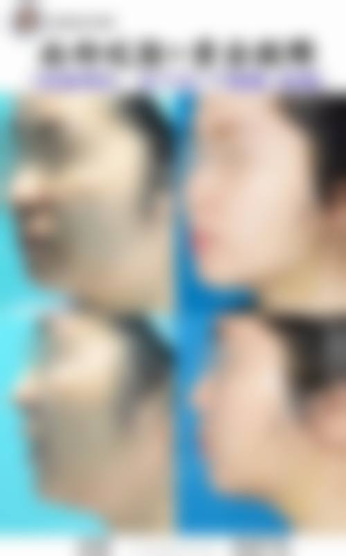 四、面部吸脂的适合人群