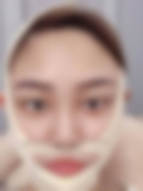 七、面部吸脂的成效评估